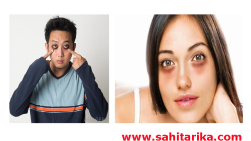 Dark Circles Hatane Ka Aasaan Aur Sahi Tarika